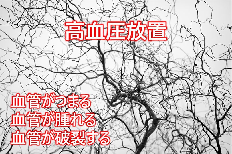 高血圧放置 血管がつまる 血管が腫れる 血管が破裂する