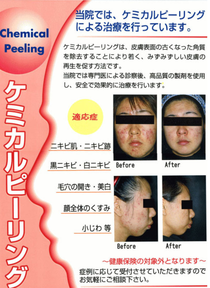 サリチル酸マクロゴールピーリングとは